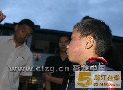 一年级1班的小明,由于偷偷拿走同学的笔,被班主任林老师指使班上其他6名同学掌掴。